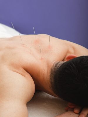 Client with acupuncture needles in back relieving pain Oceanside Physiotherapy